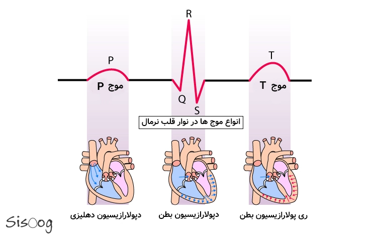 انواع موج ها در الکتروکاردیو دیاگرام