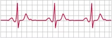 الکتروکاردیوگرام (Electrocardiogram) یا سیگنال ecg چیست؟