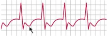 الکتروکاردیوگرام (Electrocardiogram) یا سیگنال ecg چیست؟