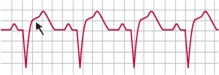 الکتروکاردیوگرام (Electrocardiogram) یا سیگنال ecg چیست؟