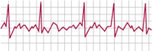 الکتروکاردیوگرام (Electrocardiogram) یا سیگنال ecg چیست؟