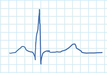 الکتروکاردیوگرام (Electrocardiogram) یا سیگنال ecg چیست؟